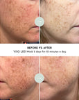 VISO - FDA Certified Red Light Therapy Mask
